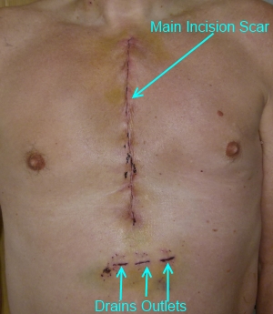Heart surgery scars
